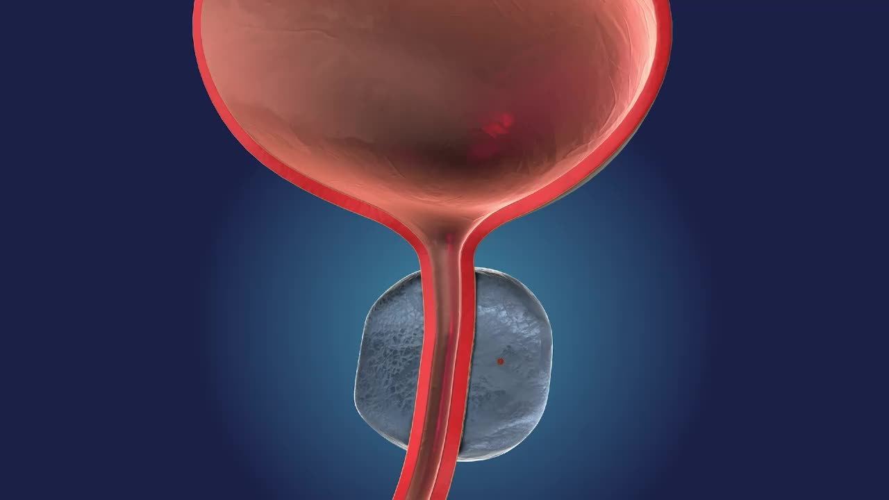Cancer de prostată