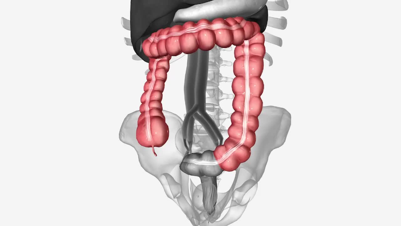 Cancerul colorectal