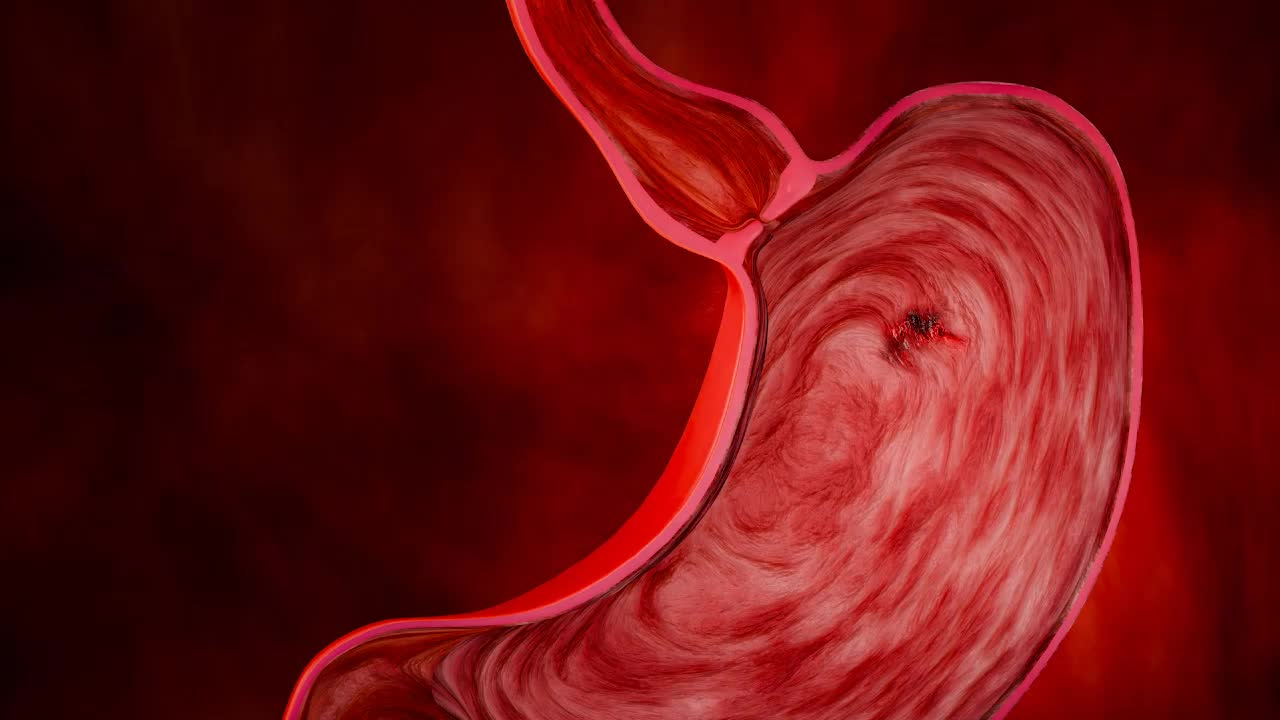 Cancerul gastric
